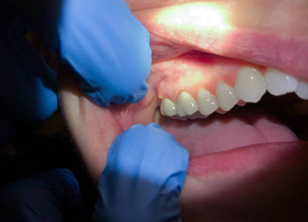 Best Emergency Treatment for Oral Infections in Veneta, OR